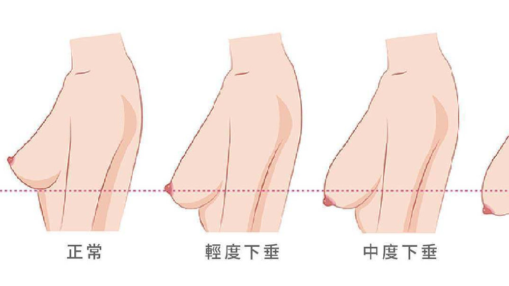 胸部下垂的困扰，全面解析与应对建议