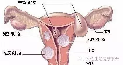 痛经与子宫切除手术，一位年轻女生的故事与反思