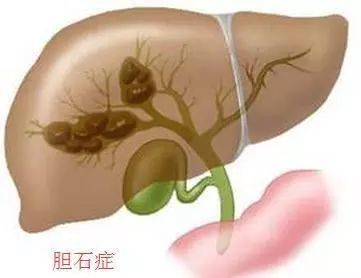 网络直播现象下的健康风险，吃播与胆结石的关联探究